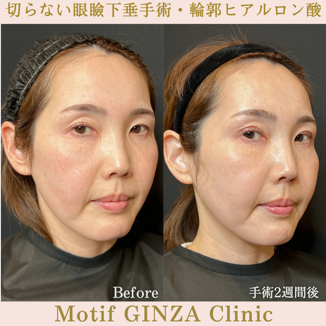 切らない眼瞼下垂手術・輪郭ヒアルロン酸(手術1か月)の写真4