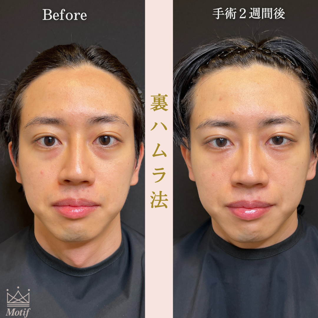 裏ハムラ法（手術３ヶ月）の写真5