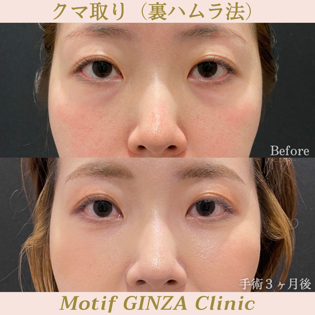 裏ハムラ法(手術12ヶ月)の写真2
