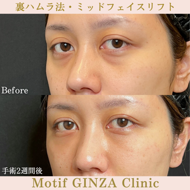 裏ハムラ法・ミッドフェイスリフト(手術5か月)の写真6