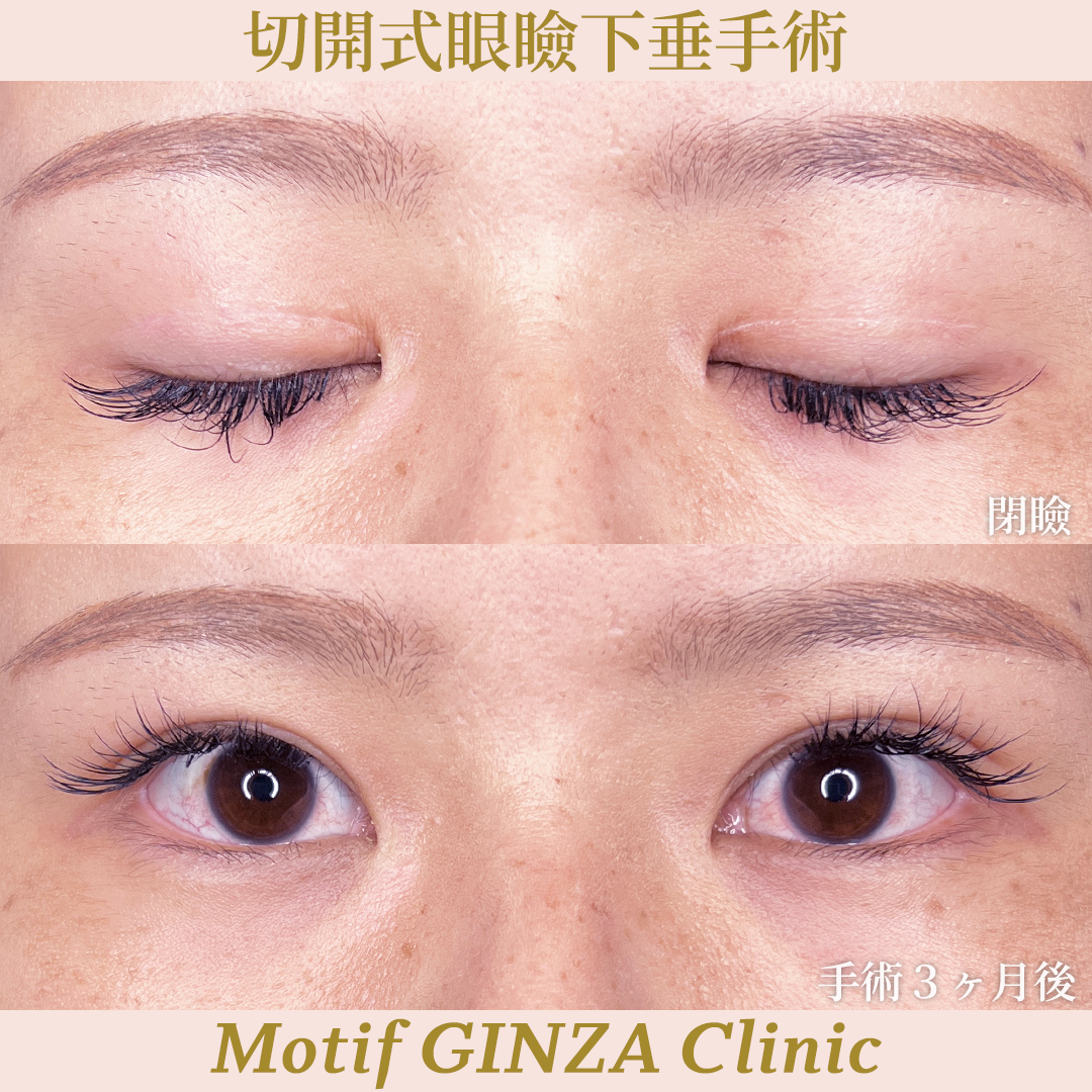 切開式眼瞼下垂手術（手術３ヶ月）の写真2