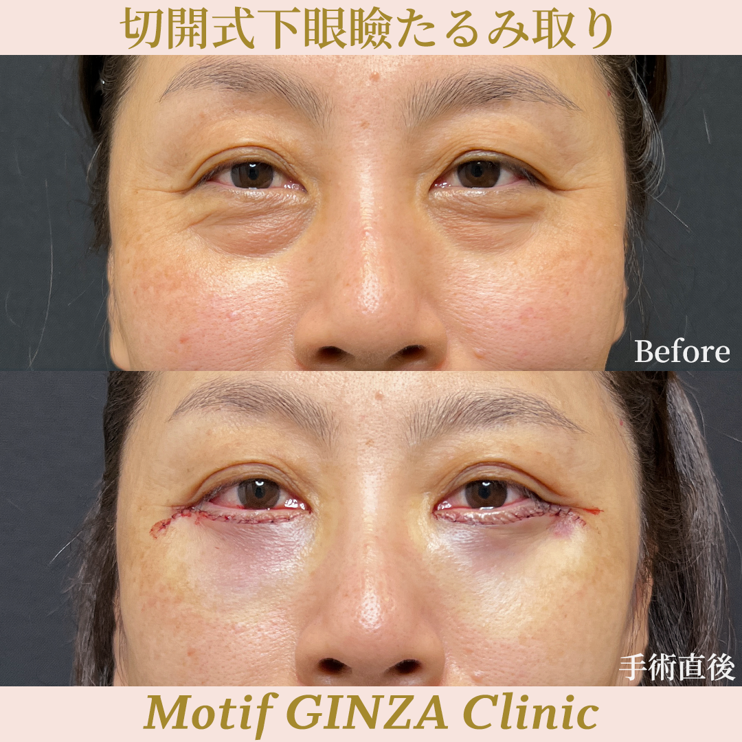 切開式下眼瞼たるみ取り（ハムラ法）（手術３ヶ月）の写真6
