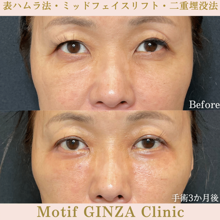 切開式下眼瞼たるみ取り・ミッドフェイスリフト・二重埋没法(手術3か月)