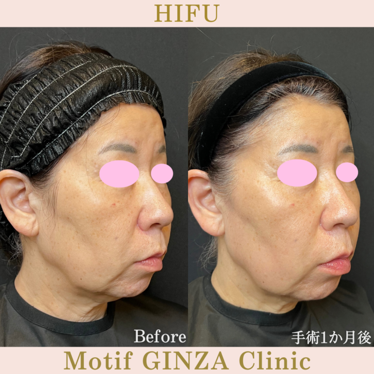 HIFU（手術1か月）の写真2